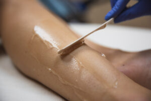A BeachGlo Aesthetics team member, wearing blue gloves, applies cooling gel on a patient before beginning laser back hair removal in Nags Head, NC. This gel helps the Diolaze XL glide across the skin for improved patient comfort.