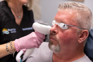 A female BeachGlo Aesthetics medical provider gently presses the IPL device to a male patient's face. Our IPL photofacials are pigment-focused sun damage treatments in Nags Head.