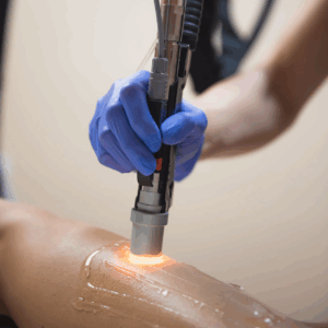 A BeachGlo Aesthetics team member, wearing blue gloves, moves the Diolaze XL device head across a section of a patient's skin. This option for laser back hair removal in Nags Head, NC is the favorite of our co-founder, Ben Kershner.