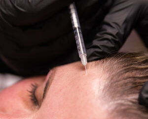 A close up on a female patient's forehead as a BeachGlo Aesthetics team member injections Botox near Kitty Hawk. This neuromodulator relaxes muscles for functional and aesthetic benefits.