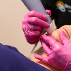 A BeachGlo Aesthetics provider, wearing black scrubs and pink gloves, presses the Exion RF Microneedling device to a female patient's chin for neck tightening in Nags Head.